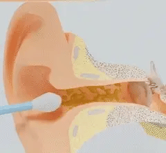 Illustration of a cotton swab pushing earwax deeper into the ear canal – showing why traditional ear cleaning can be harmful.