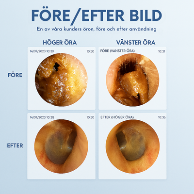 WaxClean™ - Smart öronrengöring med avancerad teknik